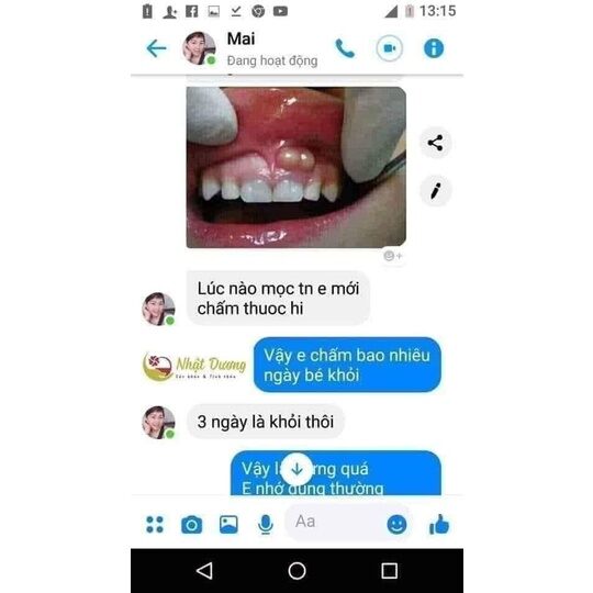 Sâu sún răng Nhật Dương