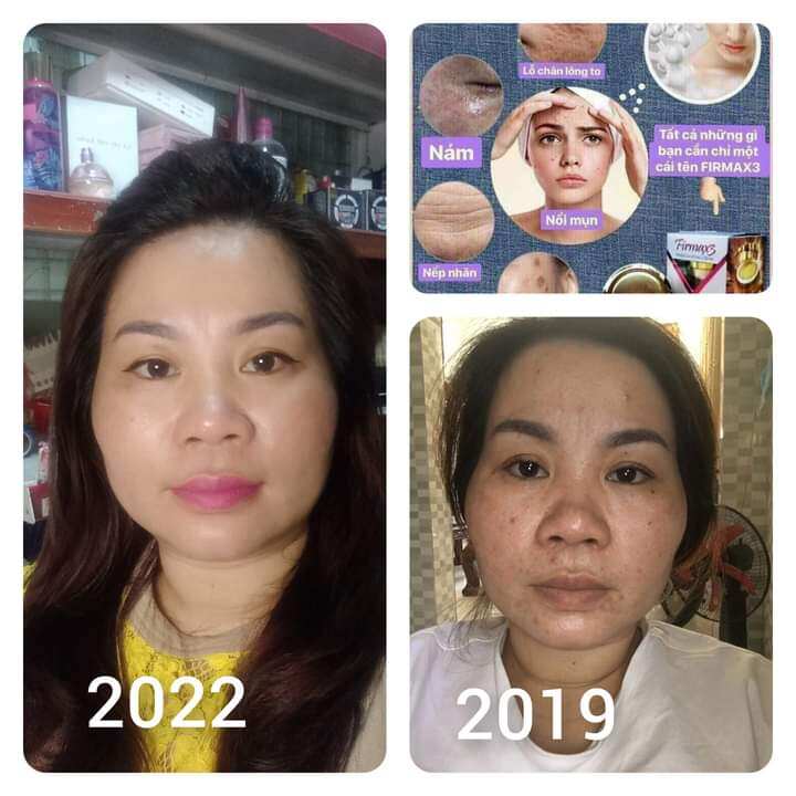 Kem thoa động tĩnh mạch ,nâng cơ trẻ hóa làn da.công nghệ nano nhật bản