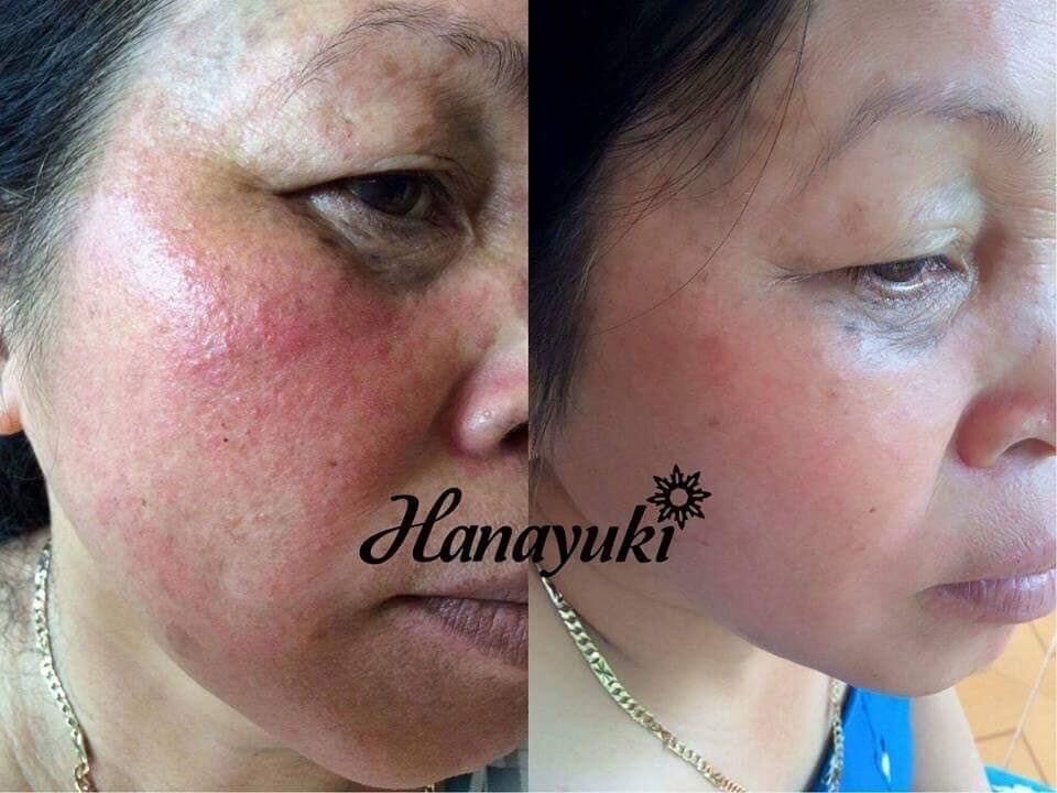 Serum Trị Nám Hanayuki - Hana Melasma