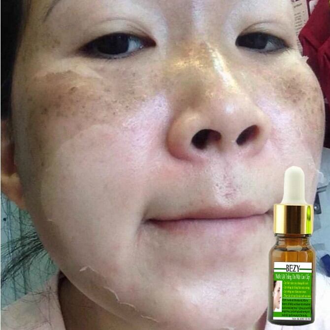 Peel Da Mặt Xóa Nám Sạm Tàn Nhang Trắng Da Bezy