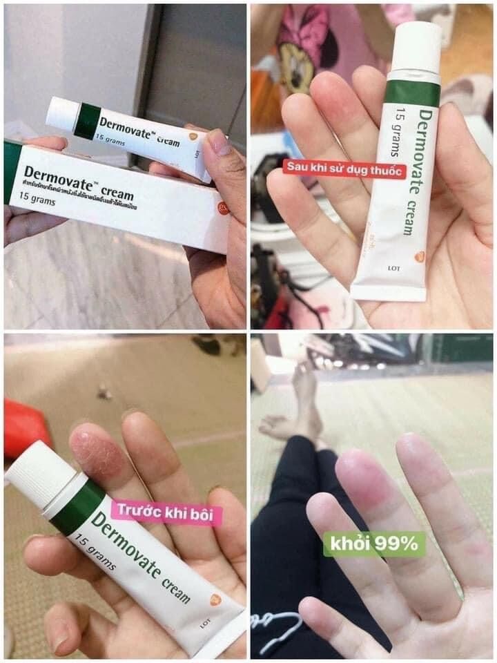 Tuýp kem vảy nến Đemovate Thái Lan