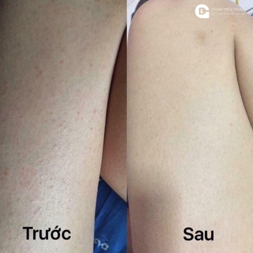 kela viêm nang lông 60ml thái lan