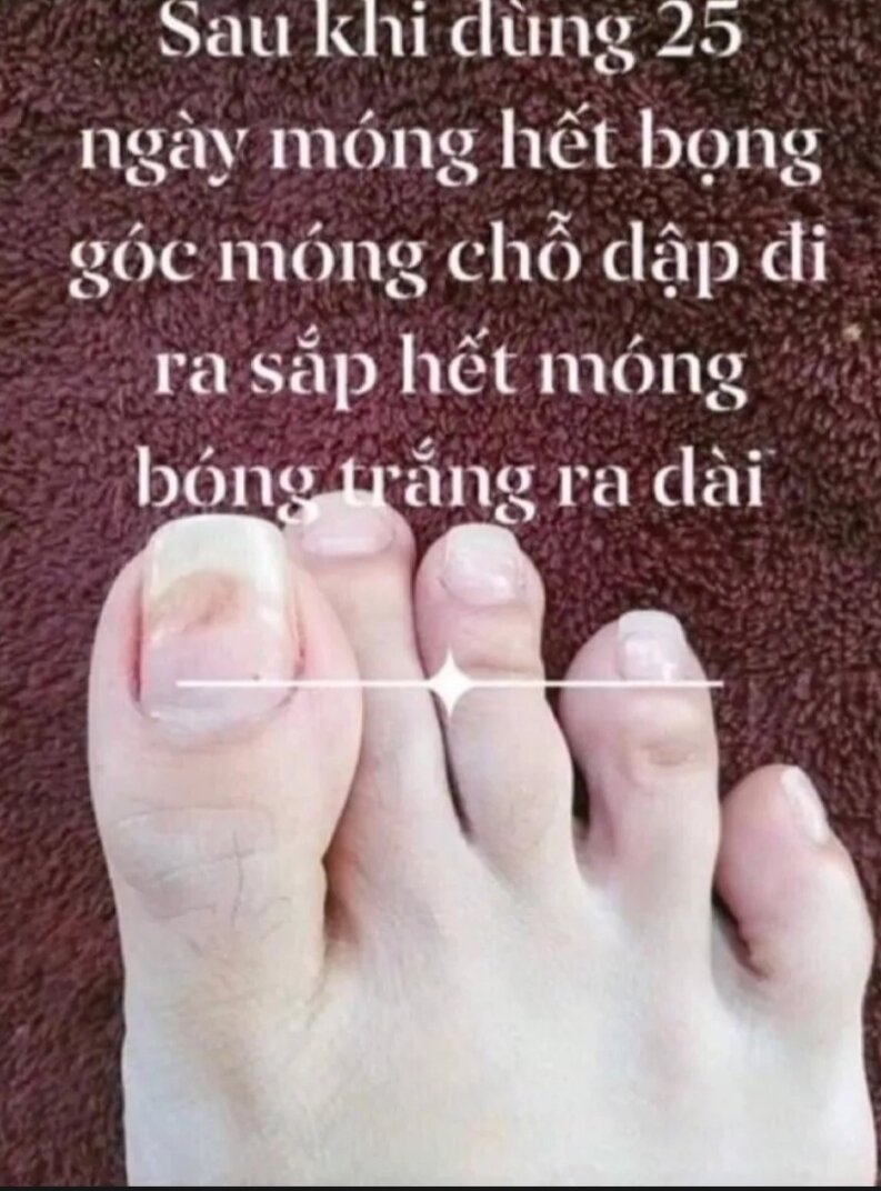 2 chai đánh bay nấm móng SH CHÍNH HÃNG