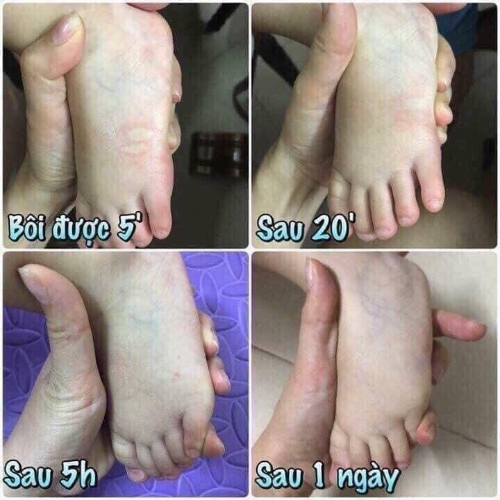 Cao bôi muỗi đốt, côn trùng cắn Thái Lan