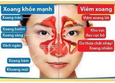 Viêm xoang Mộc Dung