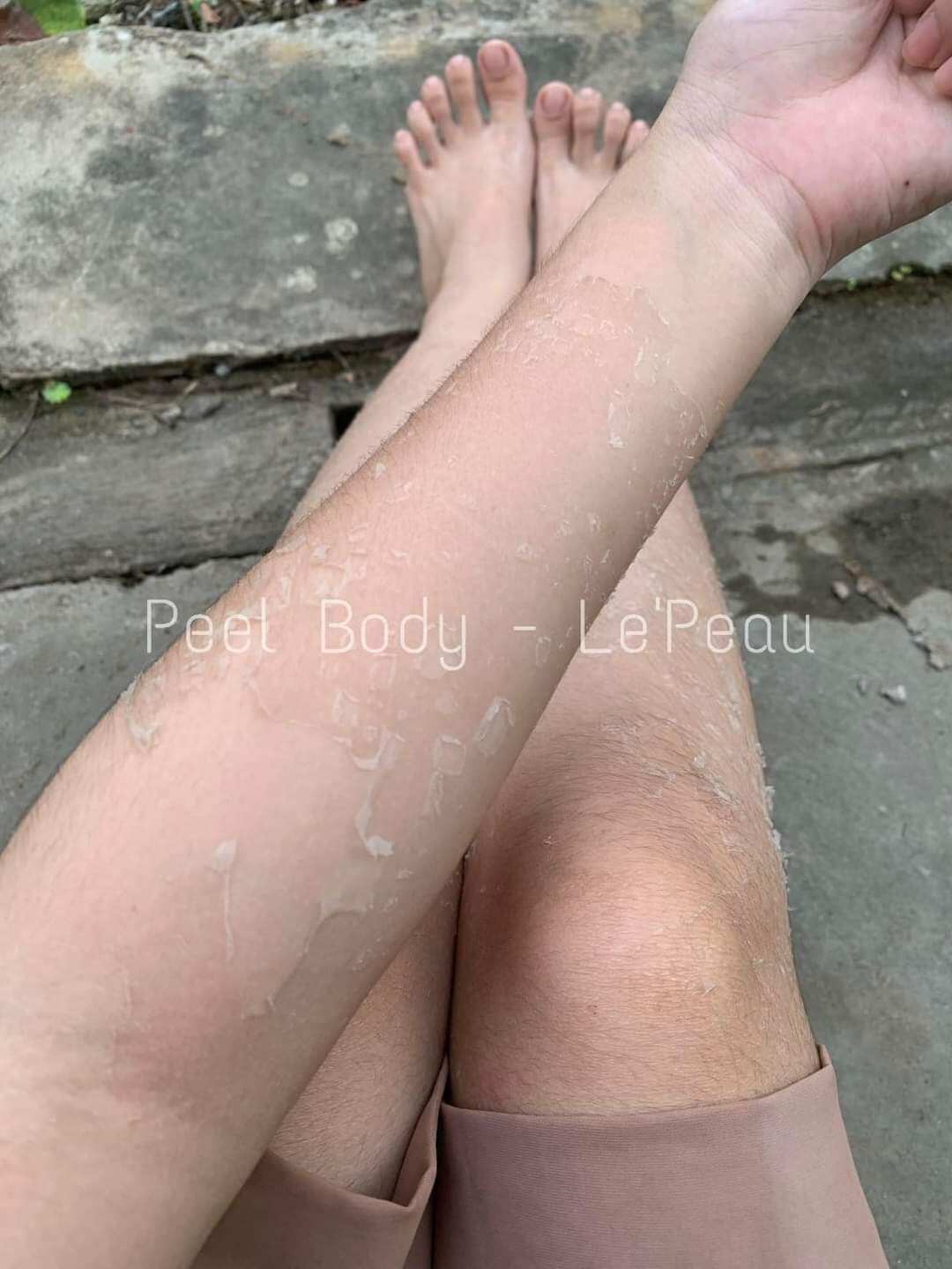 peel body,peel nach lepeau