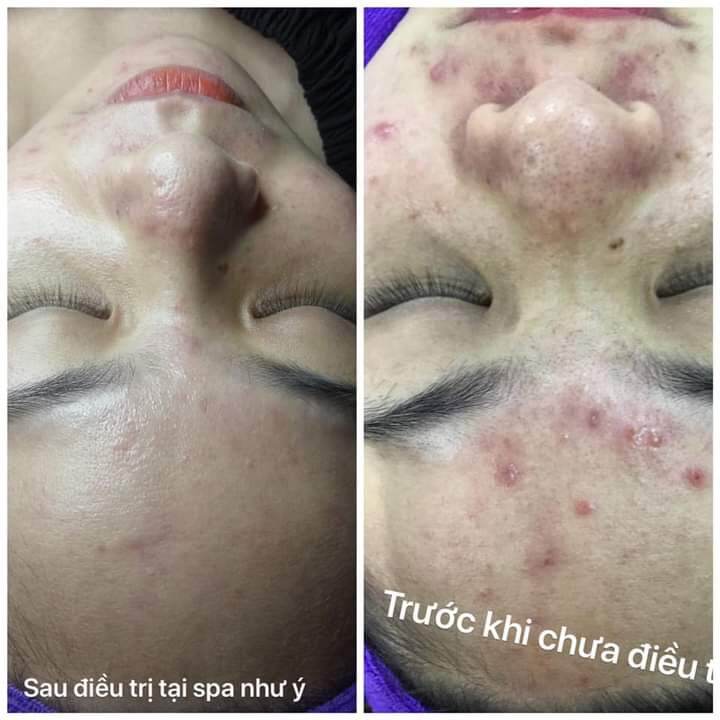 SERUM BHA MỤN HESHI