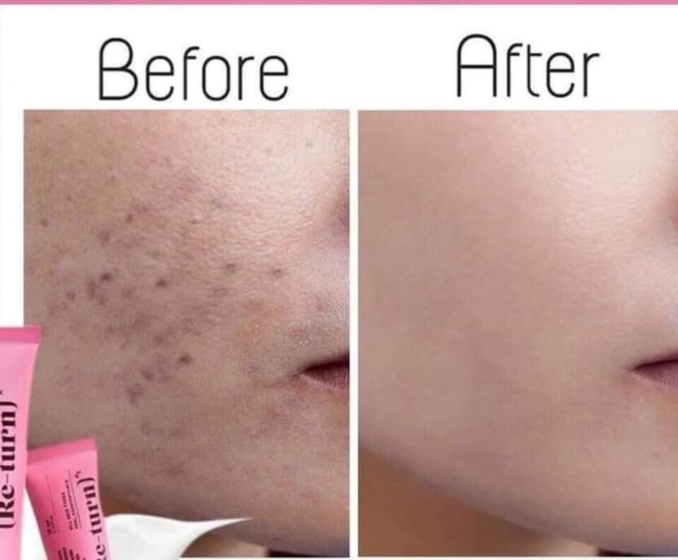 Kem đánh bay sẹo thâm MadeCera Return thái lan tuýp 15gr