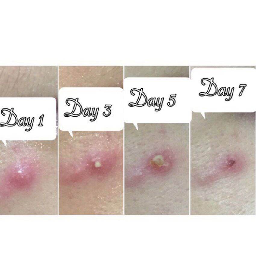 Miếng dán mụn Duoderm extra thin, chăm sóc da khỏi lo mụn mủ +5kim