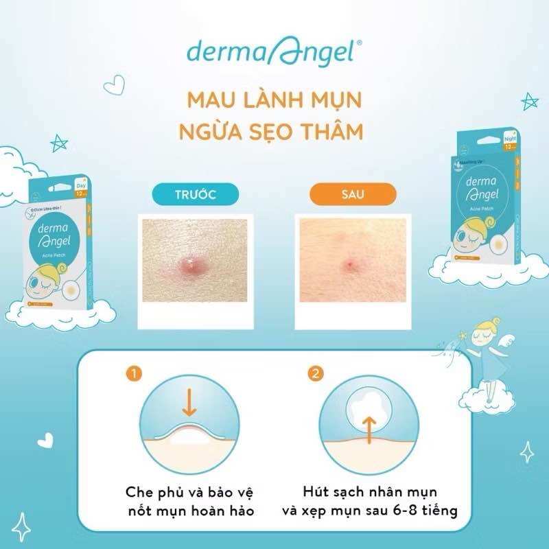 Miếng Dán Mụn Derma Angel ngày 12 miếng và đêm 6 miếng (miếng dán mụn derma angel mới) goodsgood