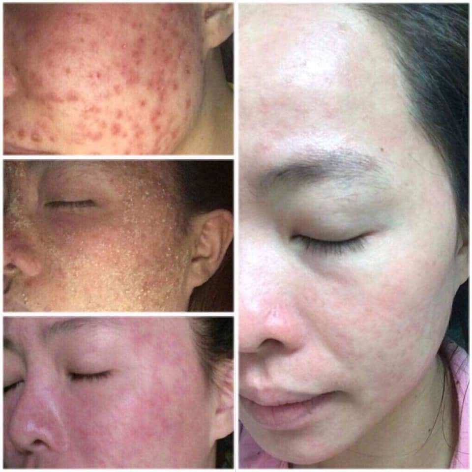 Thảo dược giảm  mụn Sắc Mộc Thiên 30ml