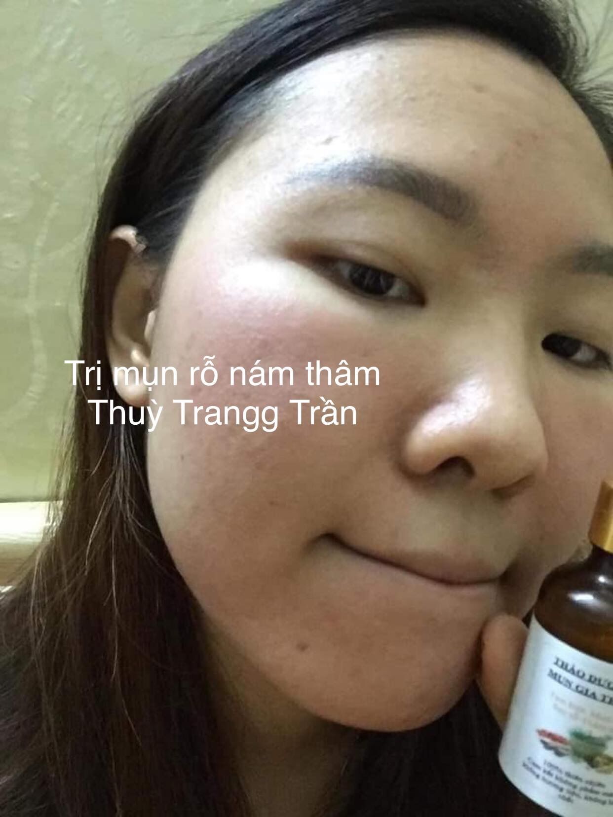 combo sạch mụn thâm rỗ 8 tuần(LO 100ML+ BOT KIEM DAU)