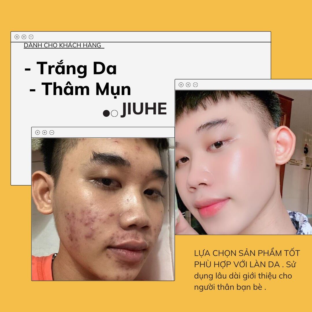 [HCM]COMBO KEM FACE JIUHE VÀ SERUM JIUHE MỤN ACNE EXTRA