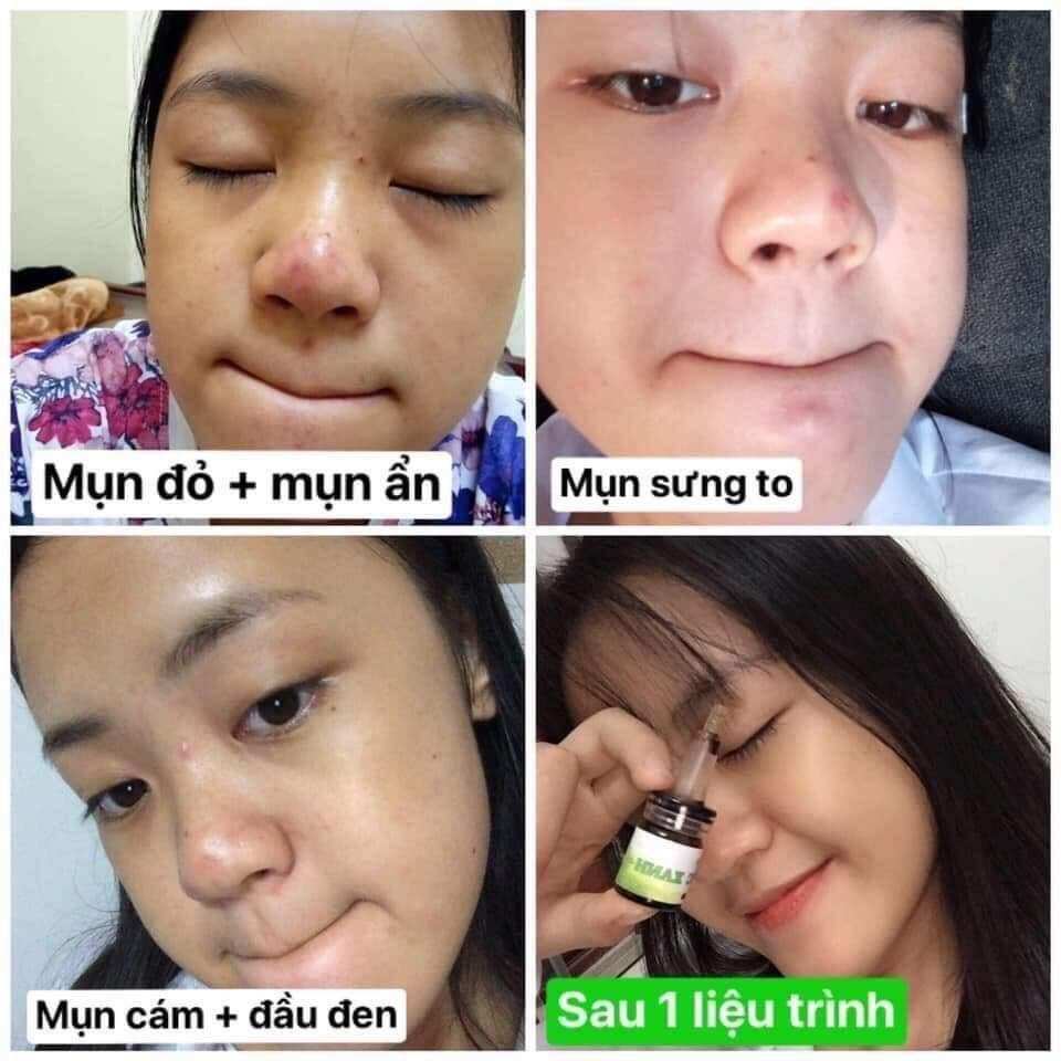 THẢO MỘC XANH SERUM MỤN THAY ĐỔI RÕ RỆT SAU 5 NGÀY SỬ DỤNG