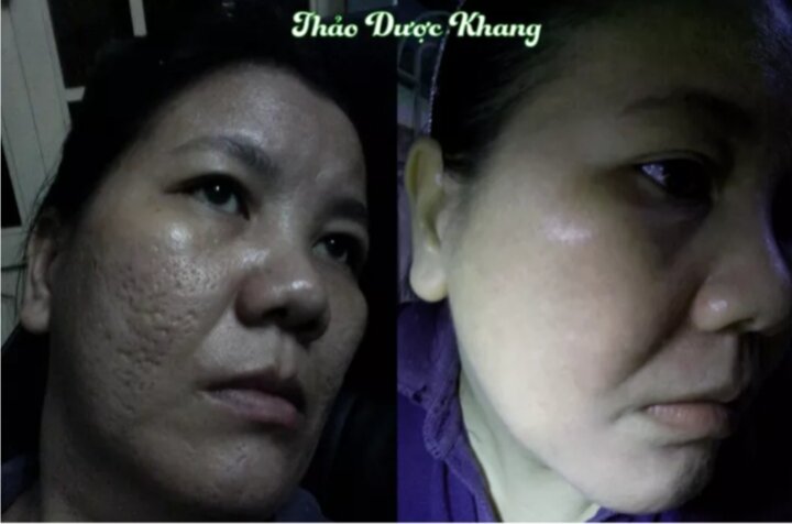 Serum Đánh Bay Sẹo Rỗ Mụn Thâm -Thảo Dược Khang 30ml