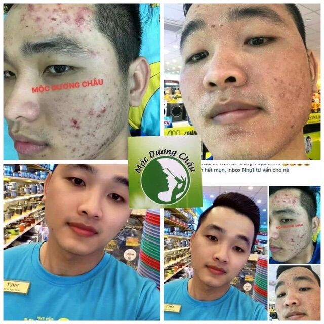 TÁI TẠO DA MỘC DƯƠNG CHÂU