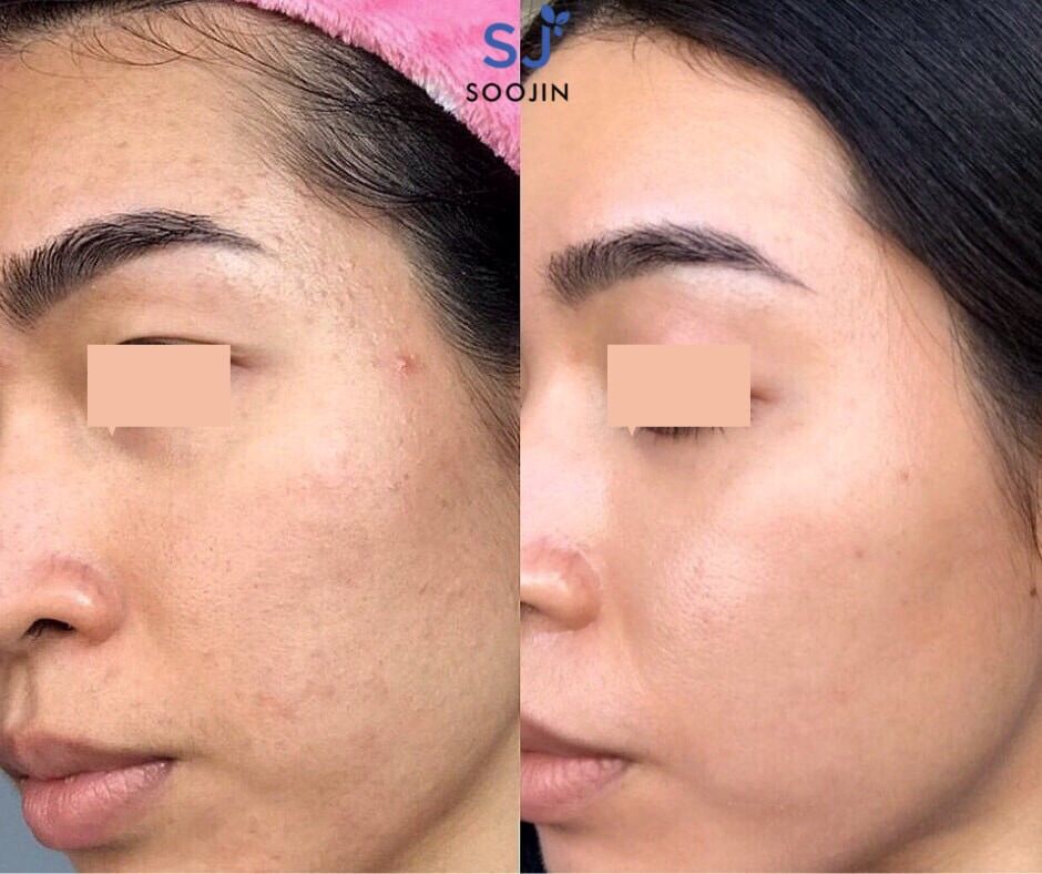 Kem thâm mụn nám soojin