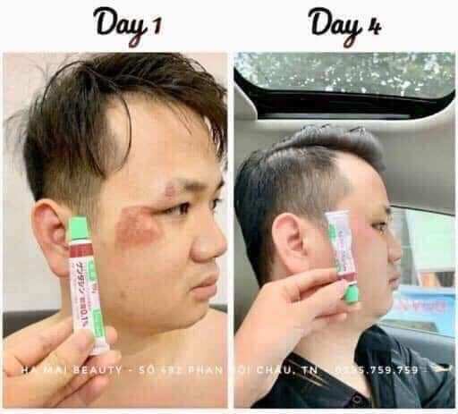 Kem mờ thâm sẹo gentacin nhật bản túyp 10g
