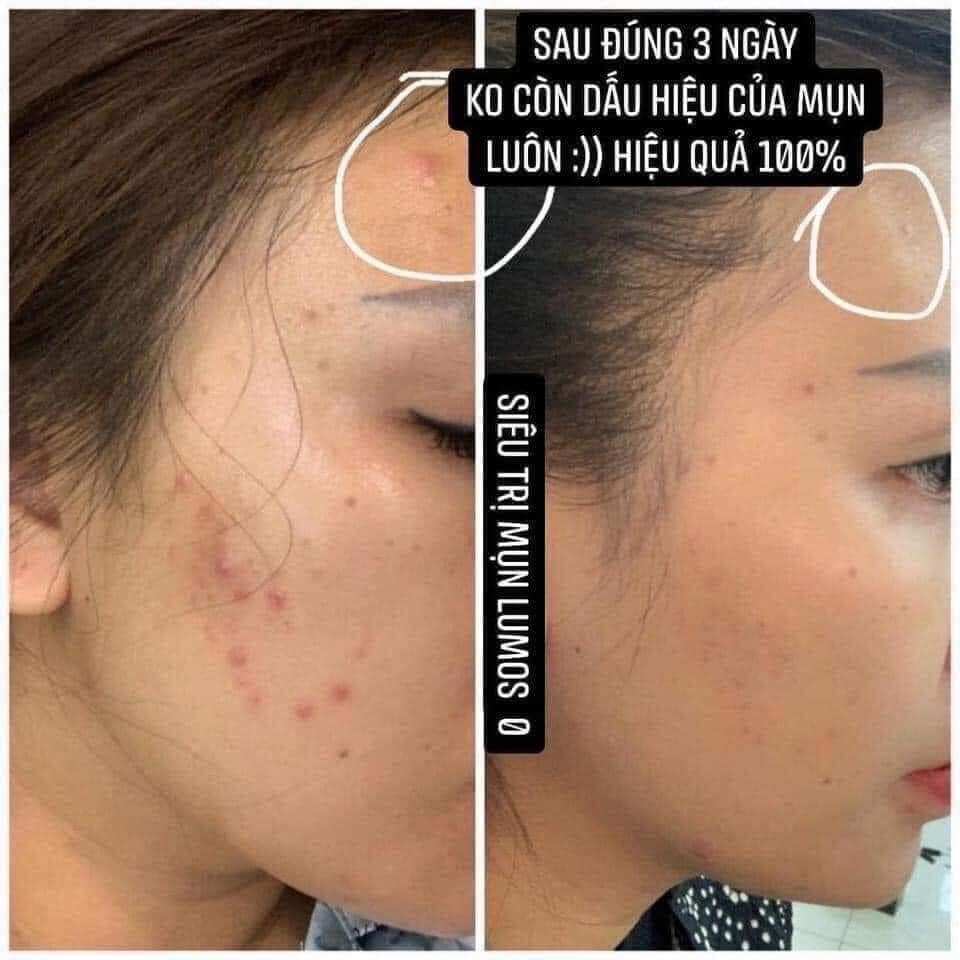 Serum mụn LUMOS ACNE 5ml chính hãng US
