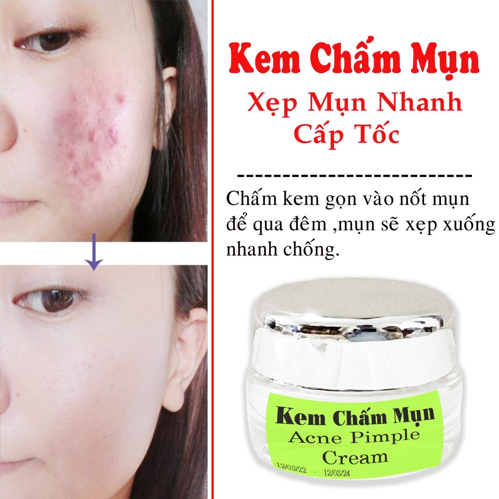 Kem chấm mụn xẹp nhanh mụn bọc,mụn viêm