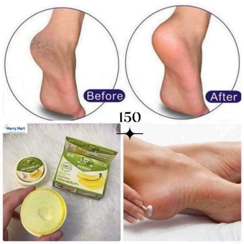 Kem chuối giảm Nứt Nẻ Gót Chân thái lan