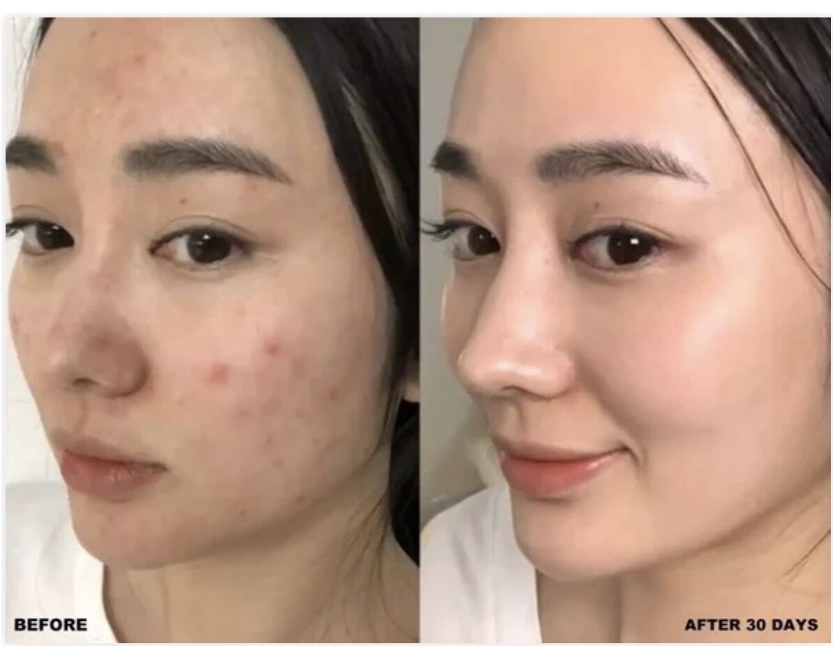 Serum rau má Centella mờ thâm mụn trắng da dành cho da thâm, da mụn 100ml