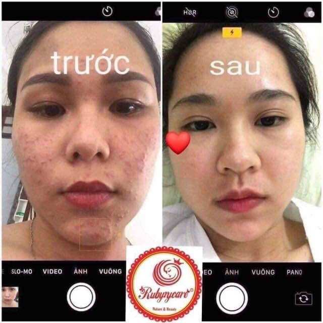 Thuốc trị mụn RubyCare