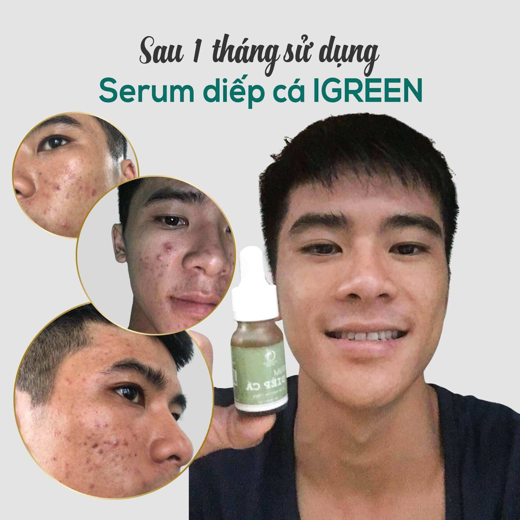 Combo Diếp Cá IGREEN (Sữa rửa mặt + Serum) – Sạch mụn, thâm