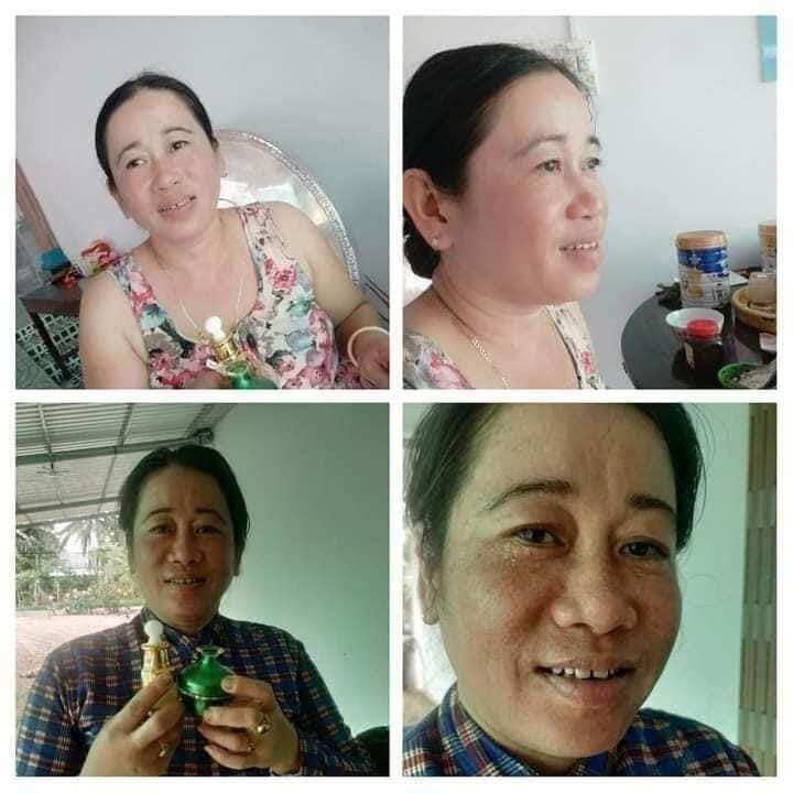 kem chuyên nám Huỳnh Đỗ