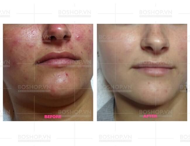 [Bản Đài 10ml] Tinh chất chấm mụn tràm trà Naruko