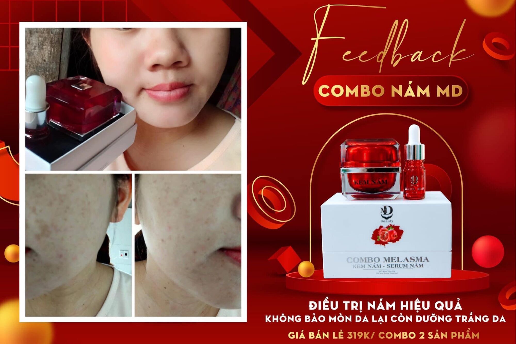 COMBO SỈ 10 HỌP KEM NÁM MD BEAUTY