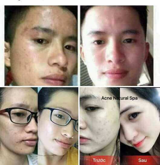 Kem Ngăn Ngừa Mụn Acne DR CELL 30gram