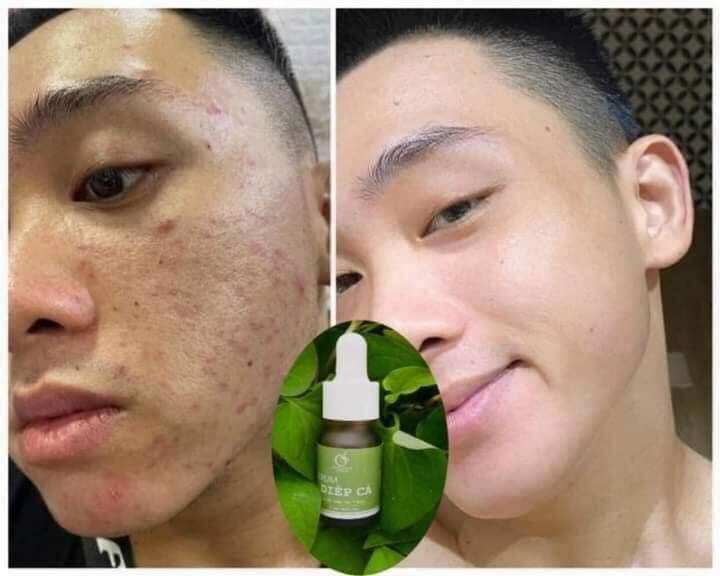 COMBO SẠCH MỤN DIẾP CÁ IGREEN