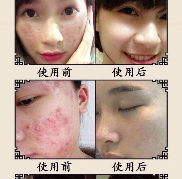 Kem Giảm Mụn Chiết Xuất Nhân Sâm