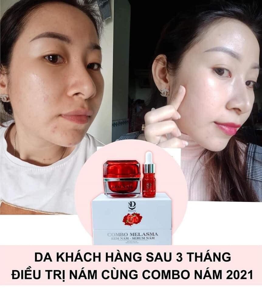 [HCM]COMBO FACE NÁM LỰU ĐỎ MELASMA MD