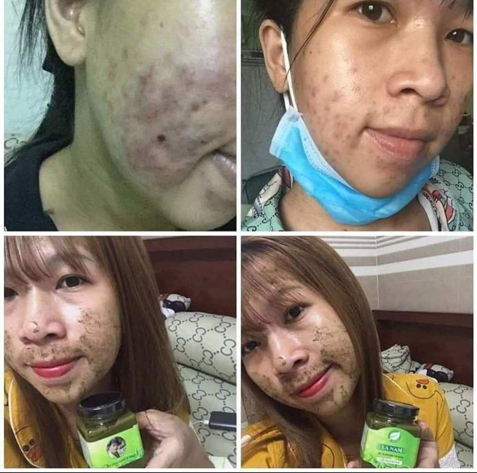 CAO LÁ NAM TR.Ị MỤN, NÁM TÀN NHANG
