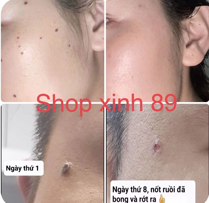 [Loại xịn] Tẩy nốt ruồi, tàn nhang,mụn cóc, mụn thịt, mắt cá handmade (lọ 3ml)