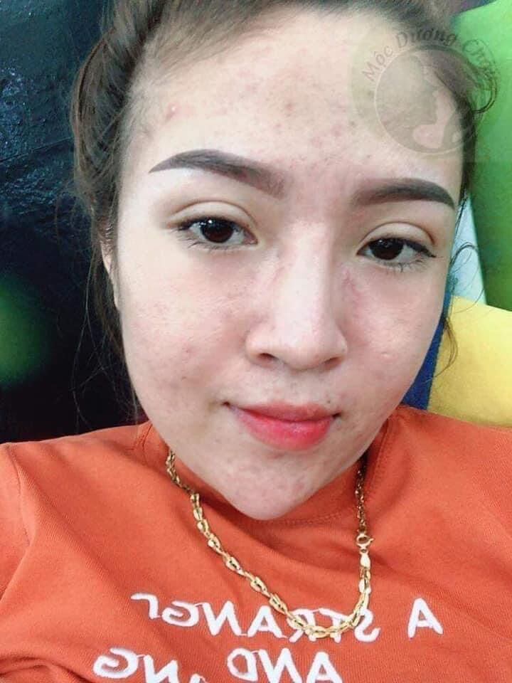 TÁI TẠO DA MỘC DƯƠNG CHÂU