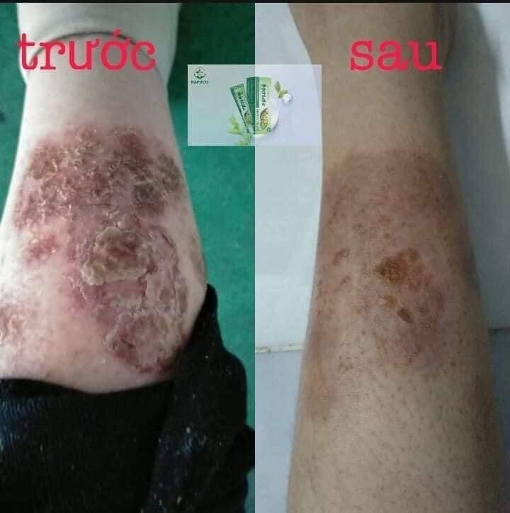 Kem bôi da thảo dược Bách Liễu 15gr