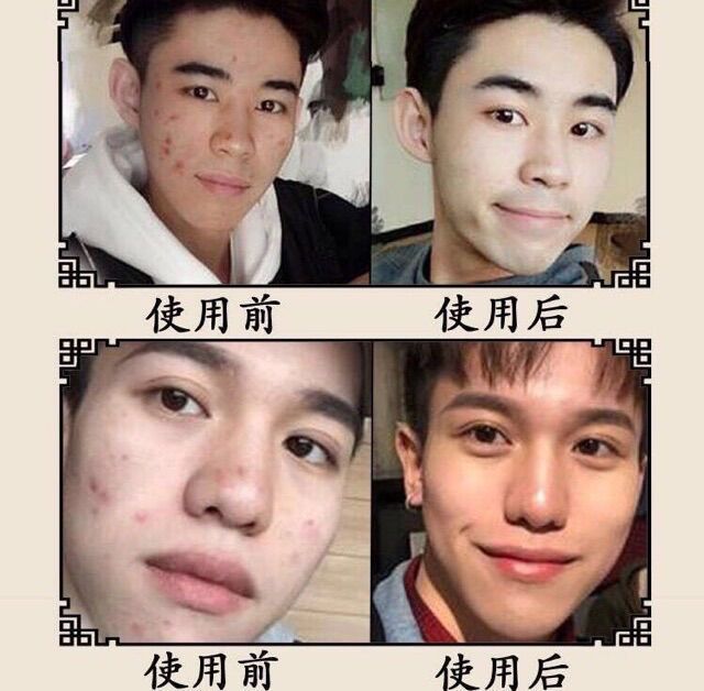 Kem Giảm Mụn Chiết Xuất Nhân Sâm