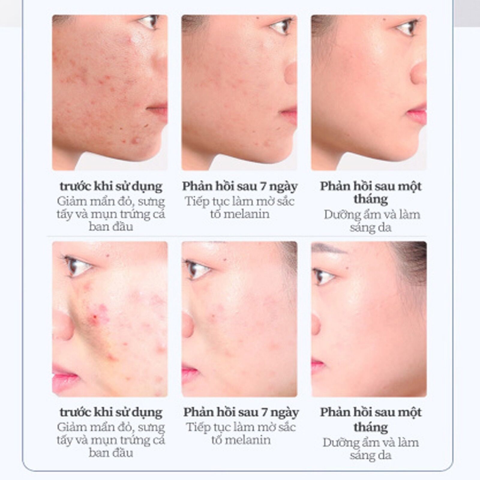 Kem Chấm Mụn Xẹp Nhanh Mụn Bọc,Mụn Viêm