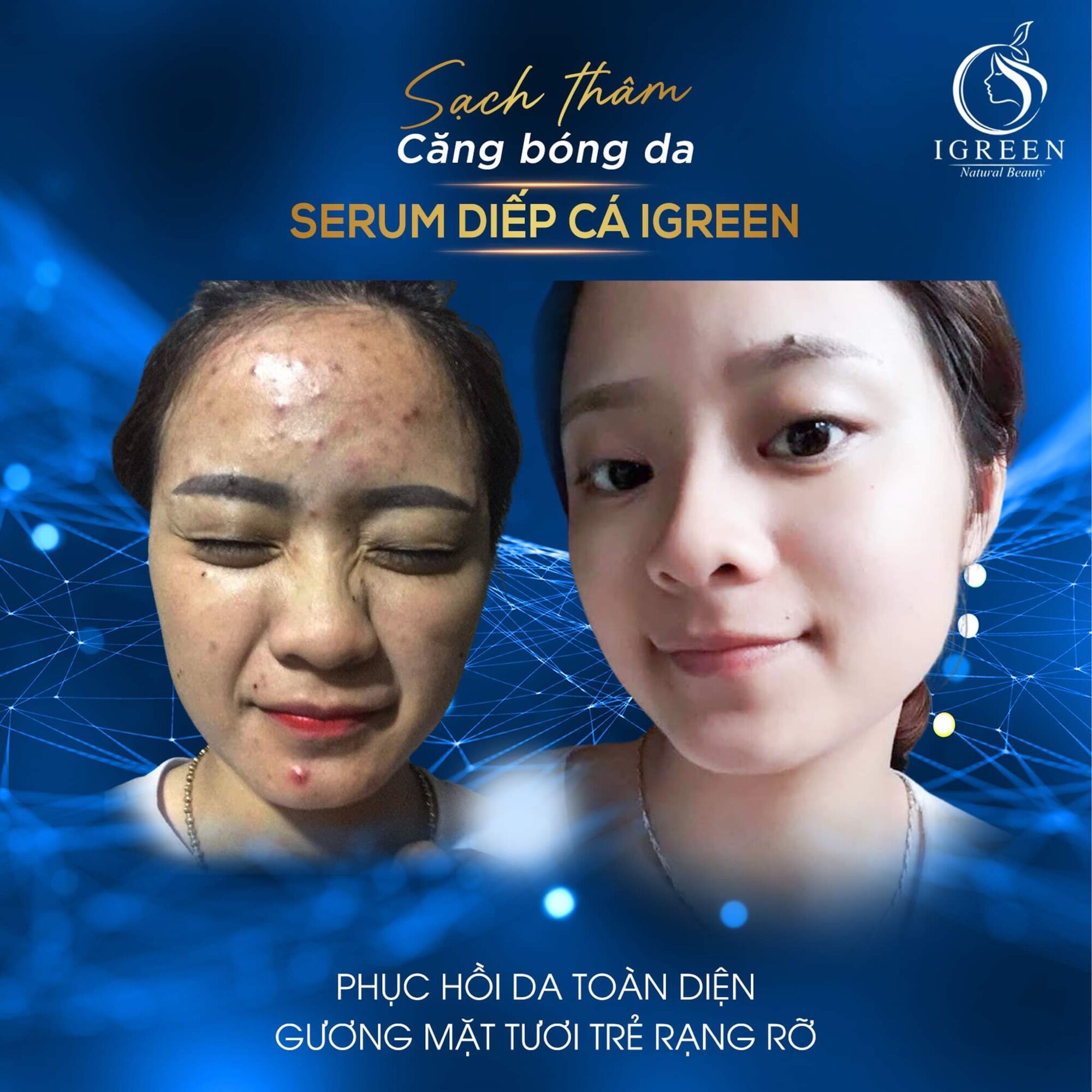 COMBO TOÀN DIỆN IGREEN-SẠCH MỤN,THÂM( serum diếp cá+sữa rửa mặt diếp cá)