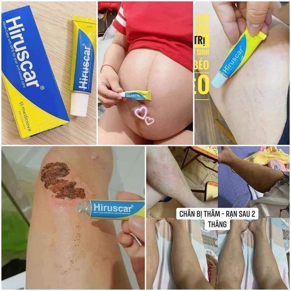 Kem bôi sẹo hiruscar thái lan
