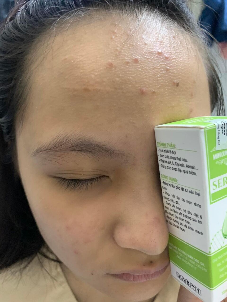SERUM MINKUN SKIN Sạch mụn