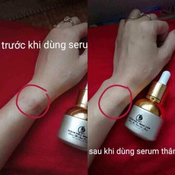 Thâm Nách, Môi, Thâm do muỗi đốt...