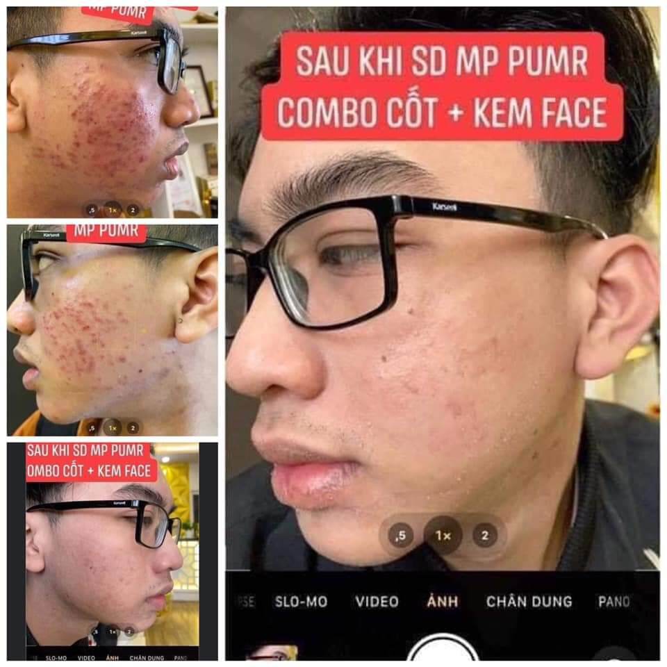 kem face chuyên mụn Huỳnh Đỗ
