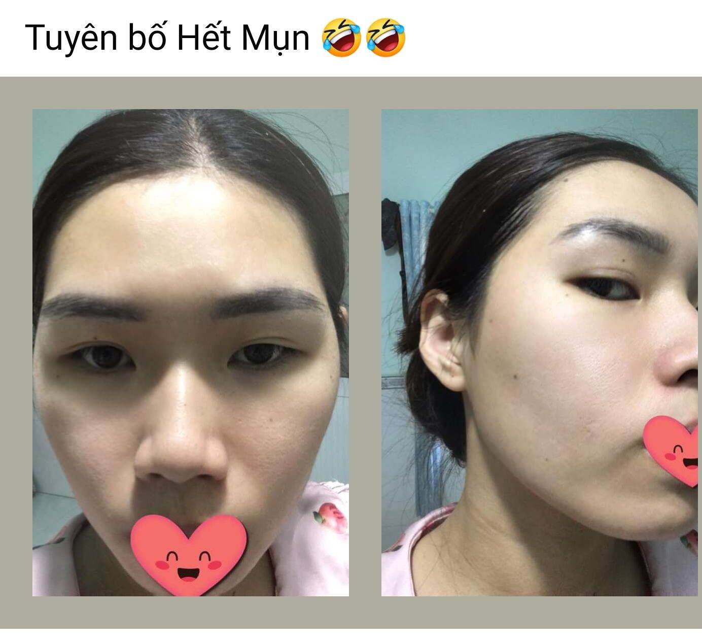 Đông y Sắc Ngọc Nữ  tái tạo da mụn, thâm