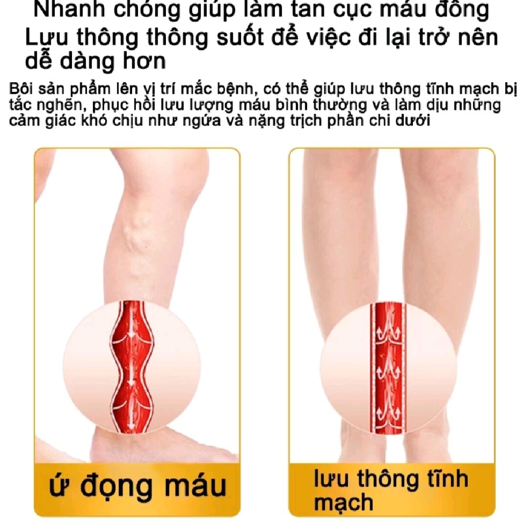 KEM BÔI SUY GIÃN TĨNH MẠCH