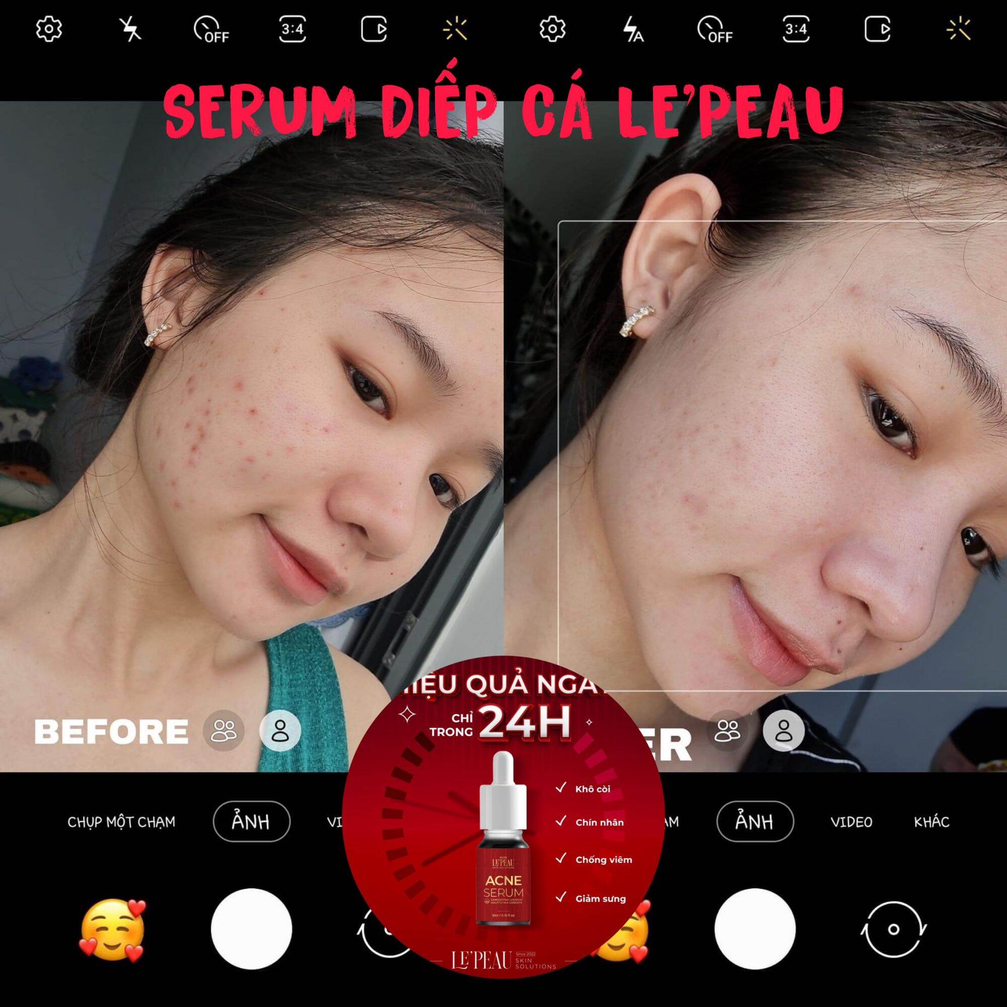 Chấm mụn Acne Serum Diếp cá (5ml) _Hoangthiensamshop