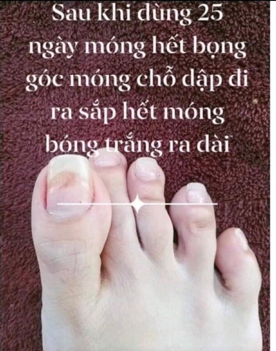 Dung Dịch Nấm Móng
